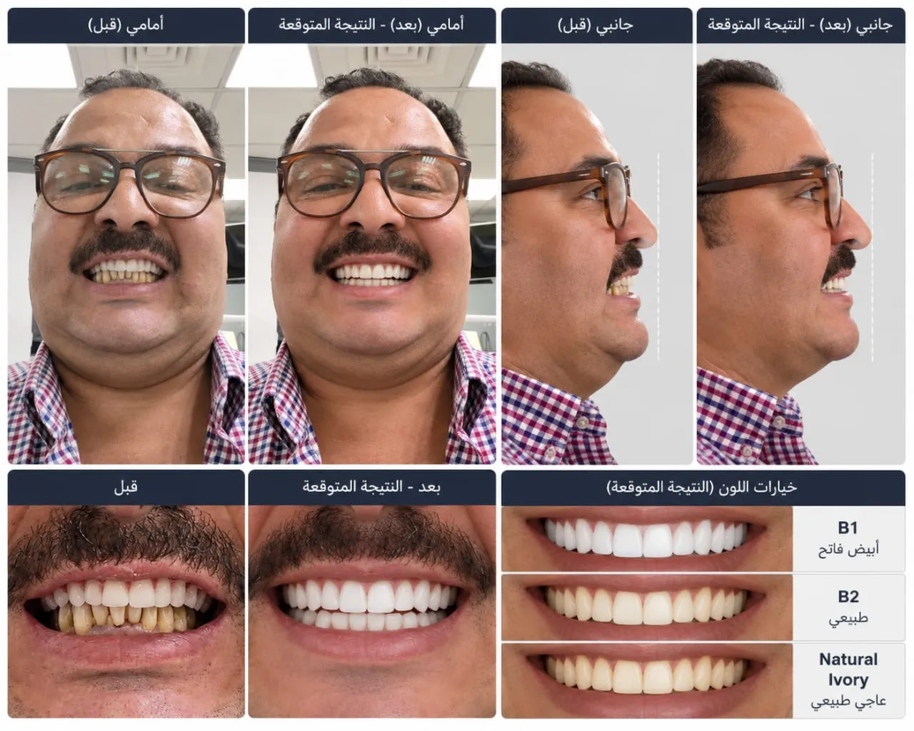 Smile design preview by Dr. Nabeel: a patient's smile before, and the new smile Dr. Nabeel designed, front and profile, with three shade options