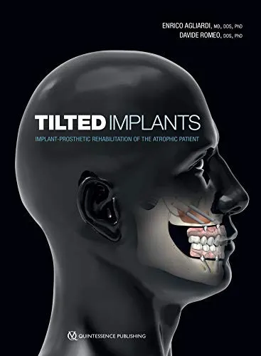 Cover of Tilted Implants